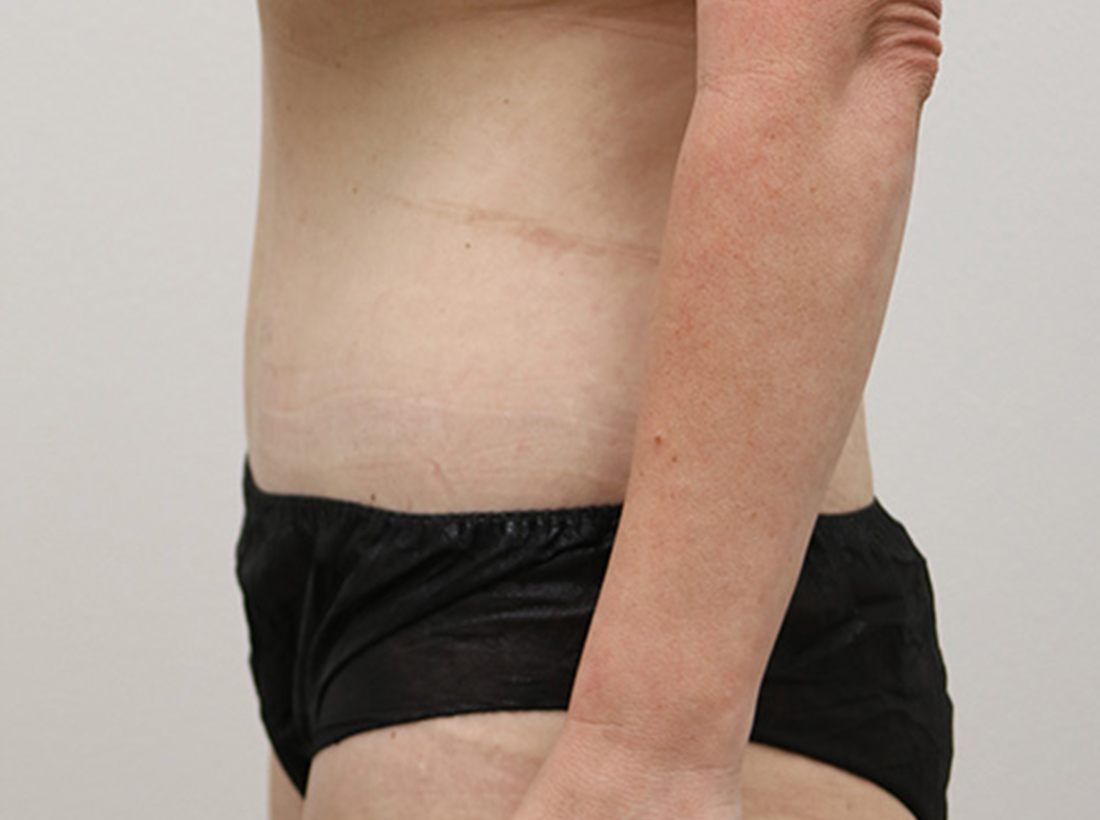 Tummy Tuck Before and After 24