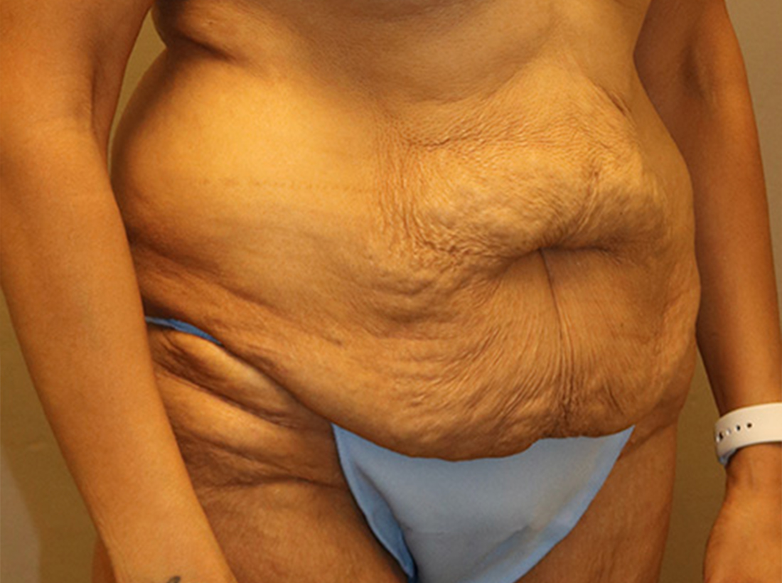 Tummy Tuck Before and After 25