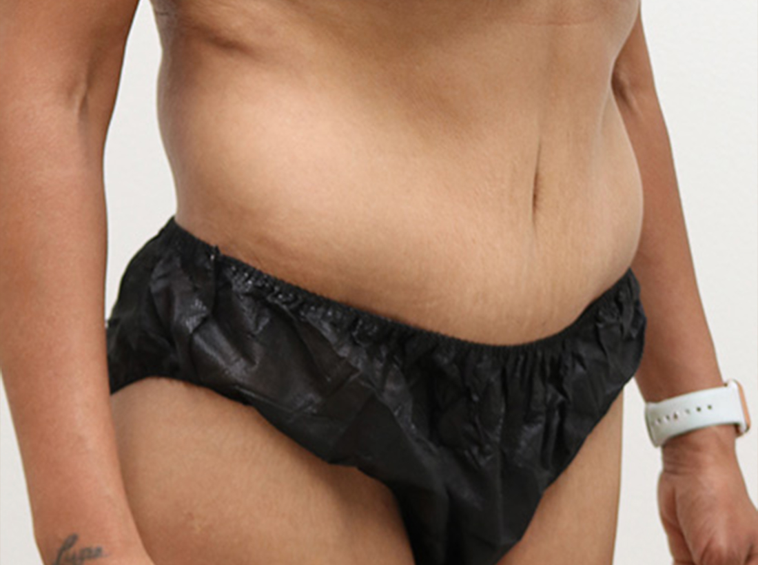 Tummy Tuck Before and After 25