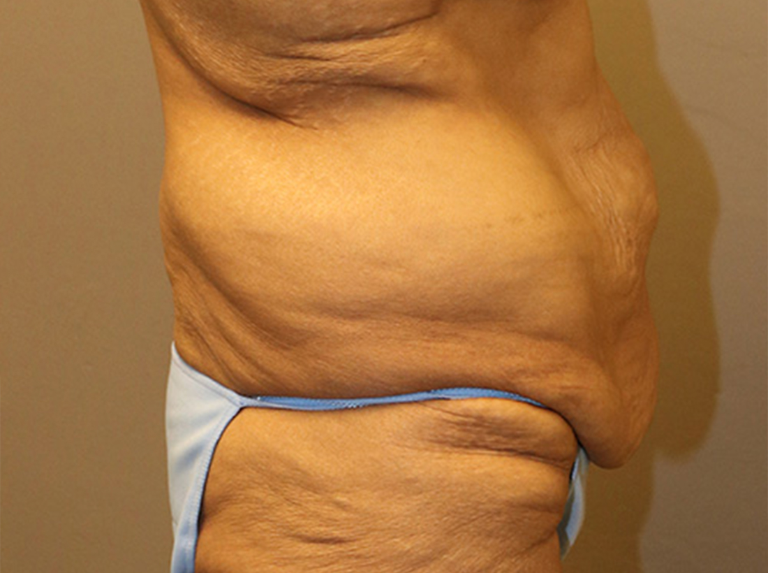 Tummy Tuck Before and After 25