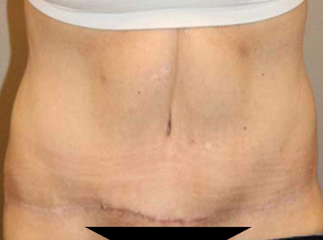 Tummy Tuck Before and After 01