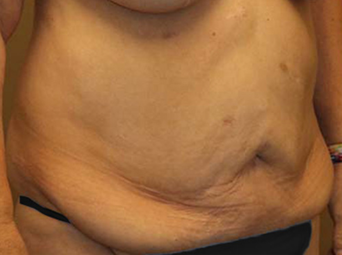 Tummy Tuck Before and After 26