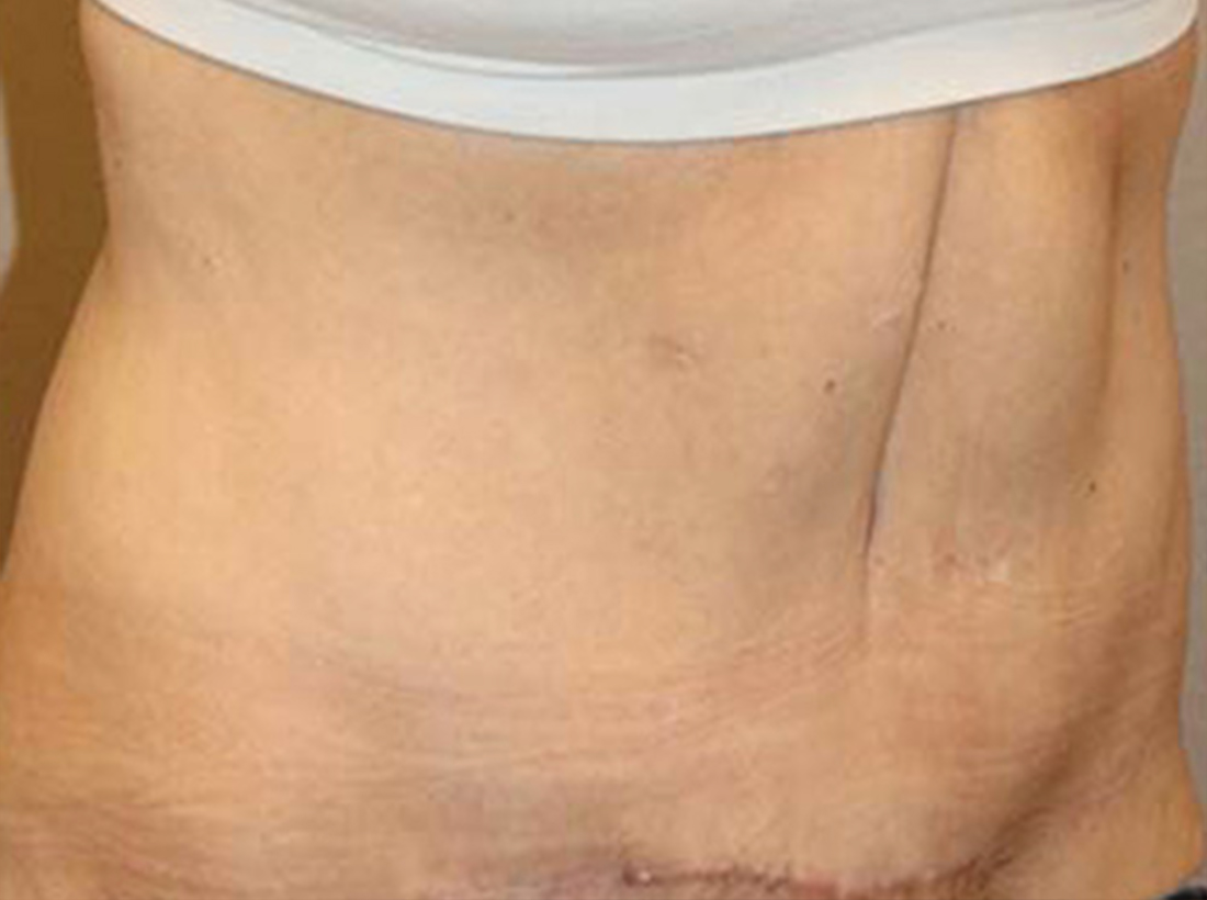Tummy Tuck Before and After 26