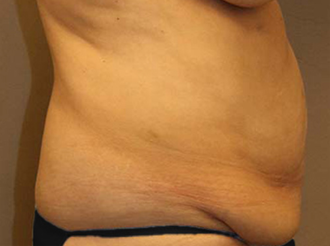 Tummy Tuck Before and After 26