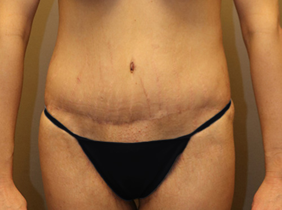 Tummy Tuck Before and After 01