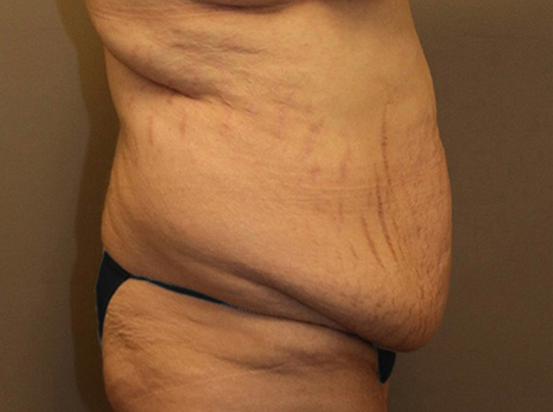 Tummy Tuck Before and After 27