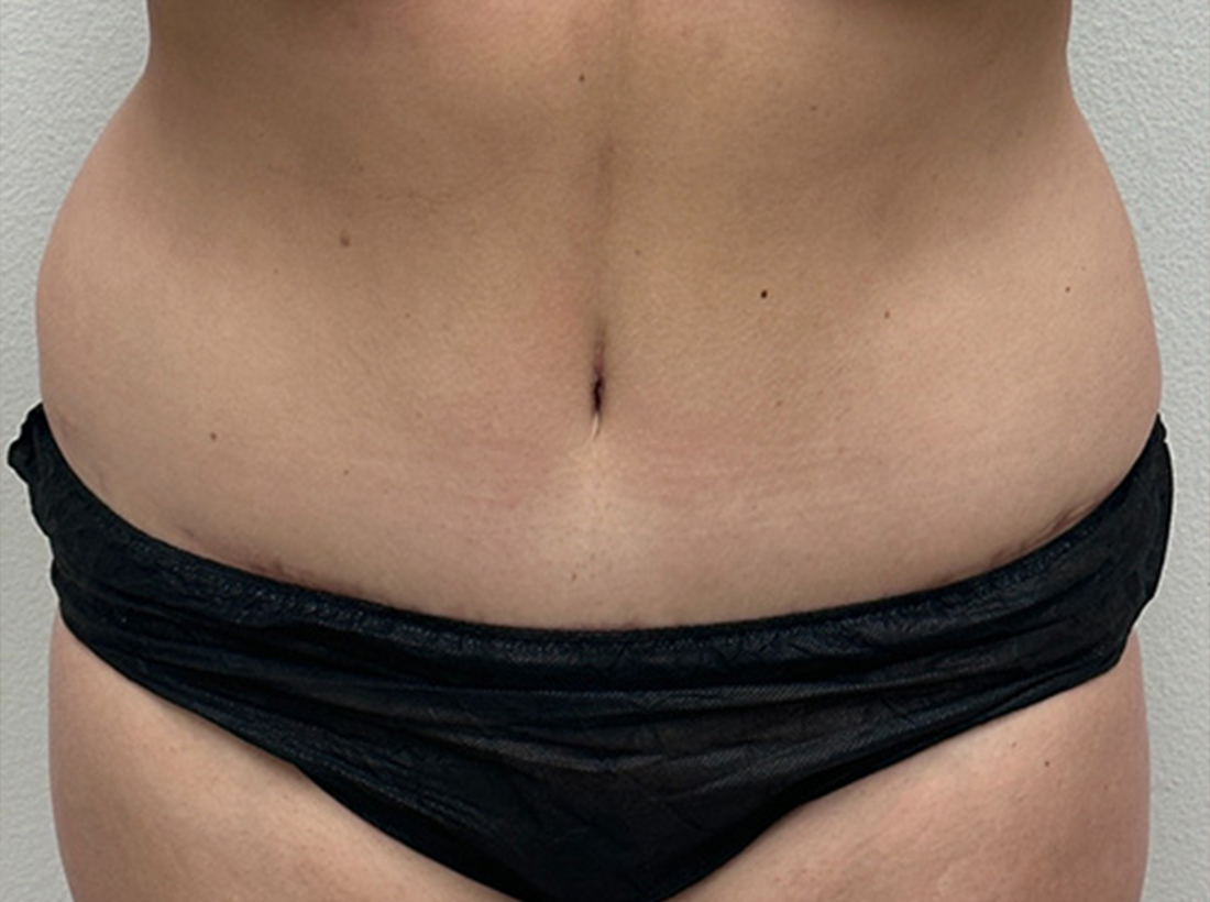 Tummy Tuck Before and After 01