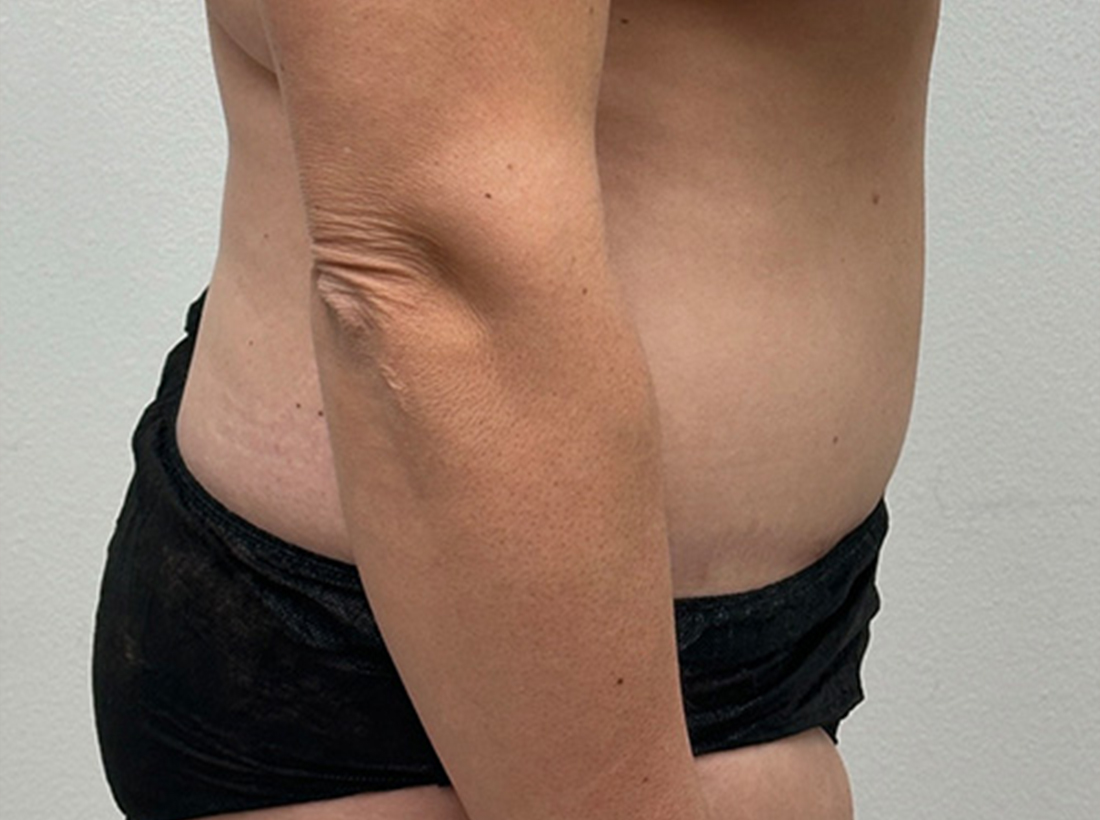 Tummy Tuck Before and After 28