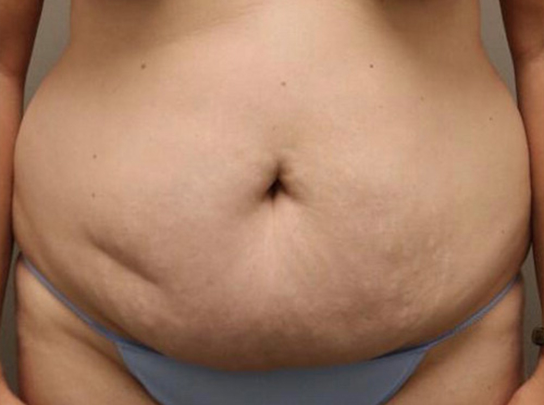 Tummy Tuck Before and After 29