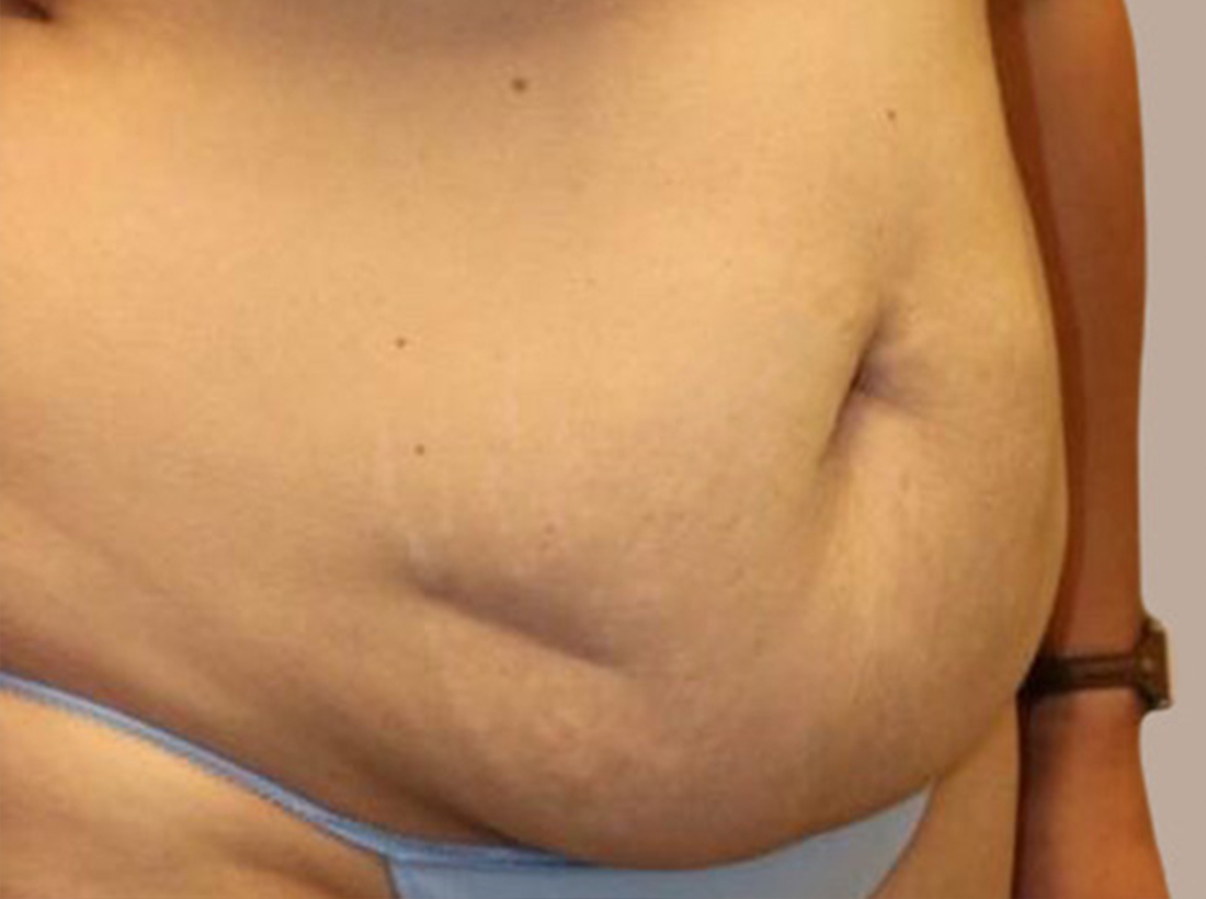Tummy Tuck Before and After 29