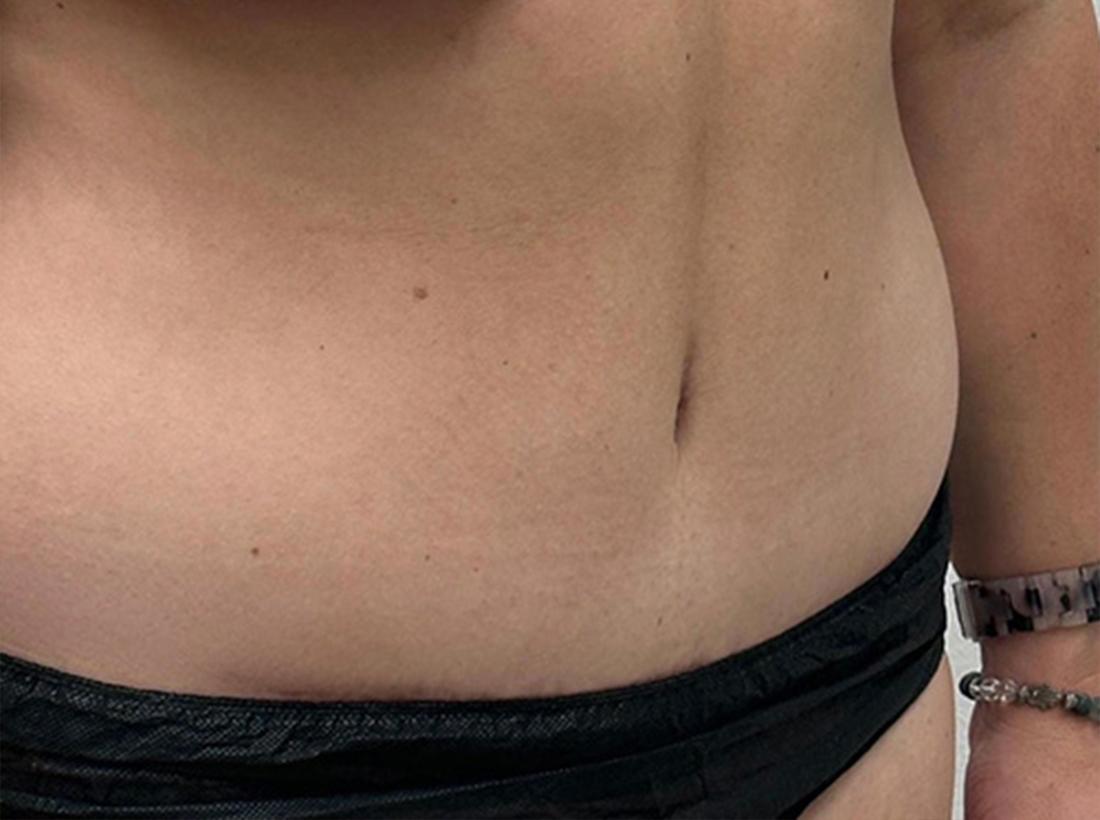 Tummy Tuck Before and After 29