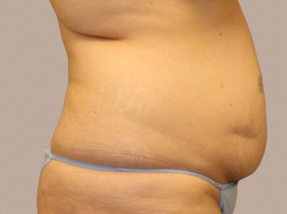 Tummy Tuck Before and After 29